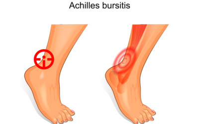 How Long Does It Take for Achilles Bursitis to Heal?